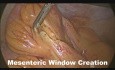 Résection de cystadénome de l'appendice par voie laparoscopique