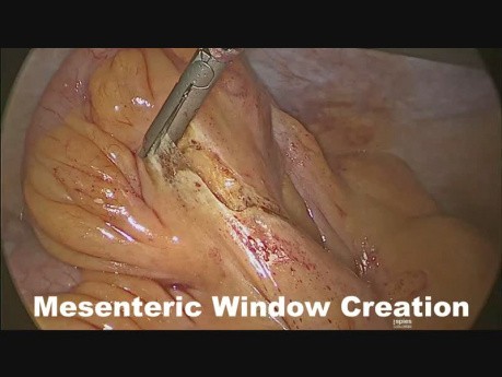 Résection de cystadénome de l'appendice par voie laparoscopique