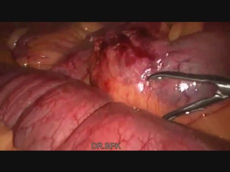 L'occlusion intestinale sur bride