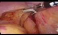 Exérèse totale du mésorectum par voie transanale (TaTME) pour cancer du bas rectum