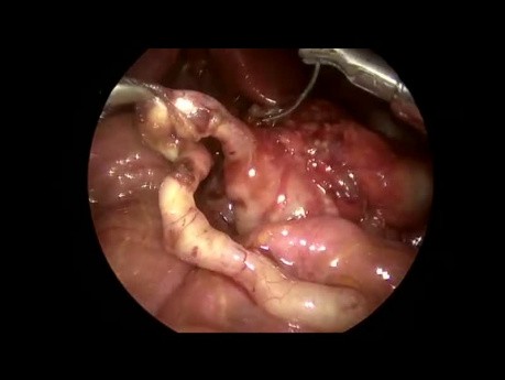 Procédure de Ladd par voie laparoscopique chez un nouveau-né avec une malrotation intestinale