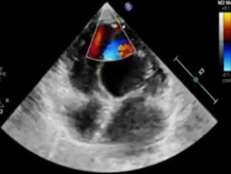 Petite communication interventriculaire (restrictive) à l'échocardiographie