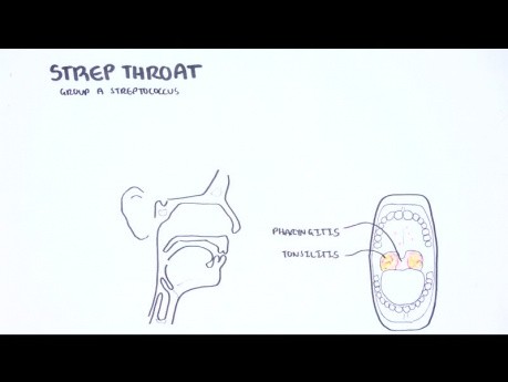 Tonsillite aiguë - causes (virales, bactériennes), physiopathologie, traitement, tonsillectomie