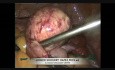 Kystectomie ovarienne par laparoscopie