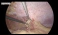 Réparation laparoscopique d'une hernie incisionnelle par la technique IPOM Plus et le maillage titanisé
