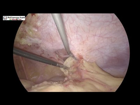 Réparation laparoscopique d'une hernie incisionnelle par la technique IPOM Plus et le maillage titanisé