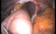 De la laparoscopie conventionnelle à la chirurgie LESS Le parcours du RGO (reflux gastro-oesophagien)