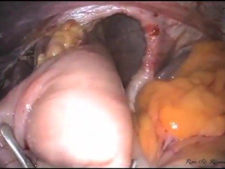 De la laparoscopie conventionnelle à la chirurgie LESS Le parcours du RGO (reflux gastro-oesophagien)