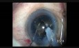 Rhexis ovale dans la gestion de la cataracte dure et de la RCP