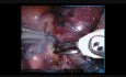 Lobectomie inférieure droite robot-assistée
