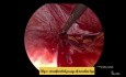 Cerclage Laparoscopique