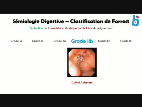 Sémiologie Digestive - Classification de Forrest