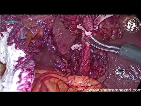 Cholécystectomie Laparoscopique Etape par Etape