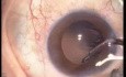 Phacoémulsification, lentille intraoculaire