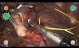 Lobectomie Inférieure Droite Robotisée CMR Versius