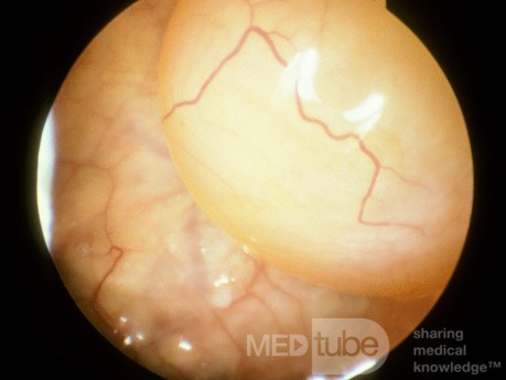 Kyste du sinus maxillaire [examen cystoscopique]