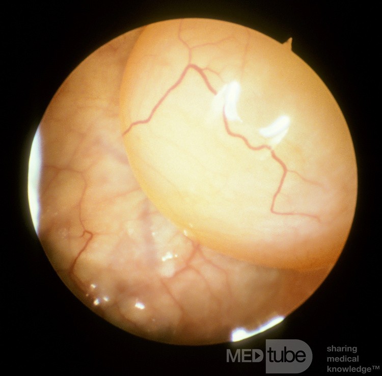 Kyste du sinus maxillaire [examen cystoscopique]