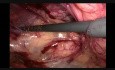 Réparation laparoscopique totalement extra-péritonéal de la hernie inguinale directe bilatérale
