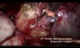 Kystectomie Ovarienne Gauche Laparoscopique Ambulatoire
