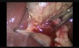 Cholécystectomie mini-laparoscopique