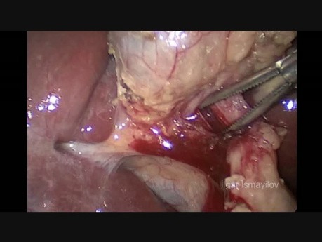 Cholécystectomie mini-laparoscopique