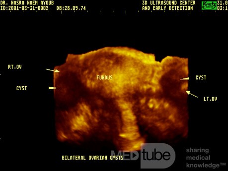  Echographie tridimensionnelle de l'utérus.