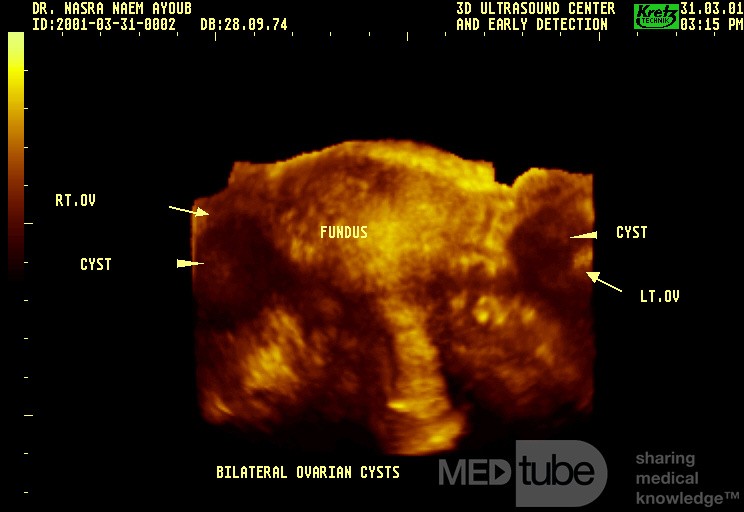 Echographie tridimensionnelle de l'utérus.