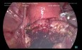 Myomectomie laparoscopique d'un fibrome cervical postérieur