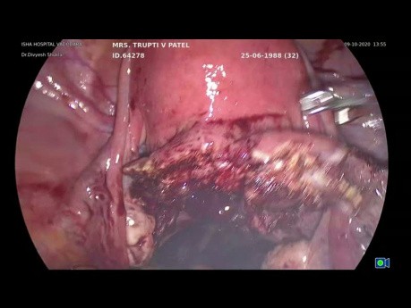 Myomectomie laparoscopique d'un fibrome cervical postérieur