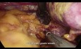 Gastrectomie totale avec curage D2 par voie cœlioscopique