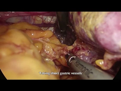 Gastrectomie totale avec curage D2 par voie cœlioscopique