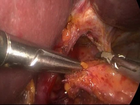 Myotomie de Heller Laparoscopique pour Achalasie avec Grande Hernie Hiatale