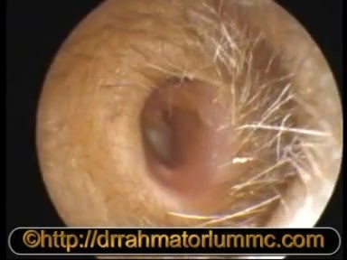 Polype dans un Cholestéatome et Perforation Postéro-Marginale