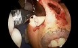 Syndrome du nez vide - implantation d'une allogreffe