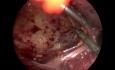 Approche laparoscopique d'une diverticulite de Meckel dans un abdomen cicatriciel 