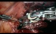 Résection de la masse tumorale de la fenêtre aorto-pulmonaire, la chirurgie assistée par robot da Vinci.
