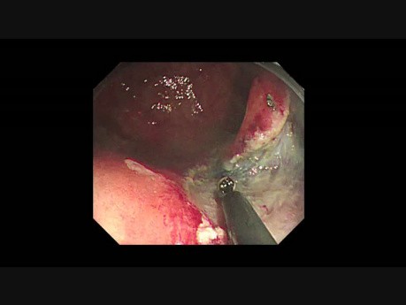 Dissection sous-muqueuse endoscopique dans un endroit difficilement accesible en utilisant un endoscope de petit calibre