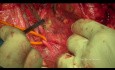 Chirurgie cytoréductive du cancer de l'ovaire. L'exentération pelvienne postérieure modifiée.