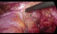 Cancer rectal récidivant - Exérèse totale du mésorectum par laparoscopie