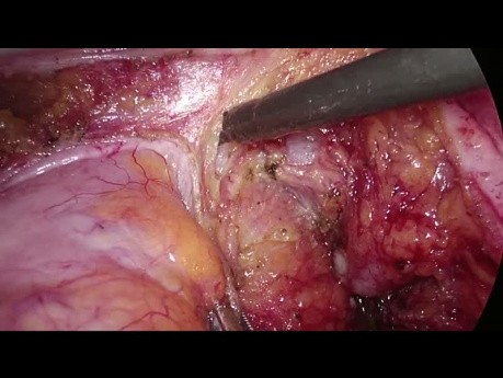 Cancer rectal récidivant - Exérèse totale du mésorectum par laparoscopie