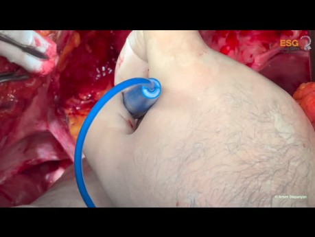 Chirurgie Cytoréductive du Cancer de l'Ovaire. Version non éditée: Partie I Haut Abdomen