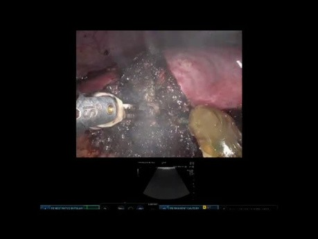 Résection Robotisée d'un Carcinome Hépatocellulaire du Segment VI dans un Foie Cirrhotique avec Manœuvre de Pringle intracorporéale