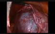 Résection d'un gros kyste paratubaire par voie laparoscopique
