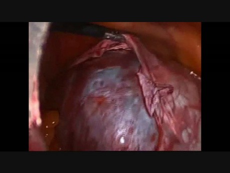 Résection d'un gros kyste paratubaire par voie laparoscopique