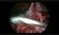 Tératome kystique de l'ovaire pendant la grossesse - intervention laparoscopique