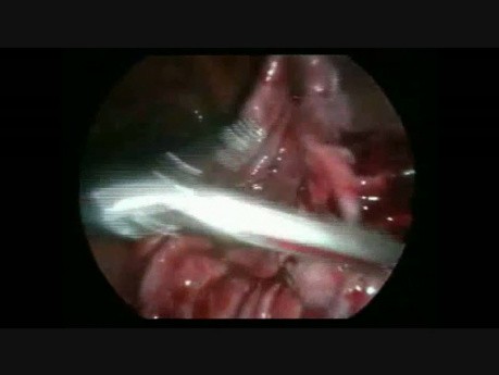 Tératome kystique de l'ovaire pendant la grossesse - intervention laparoscopique
