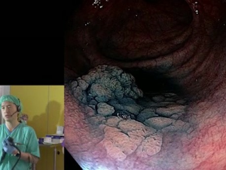 La dissection sous-muqueuse endoscopique (ESD) de l'adénome du rectum - prof. Yutaka Saito