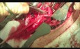 Déconnexion chirurgicale de la fistule trachéo-oesophagienne