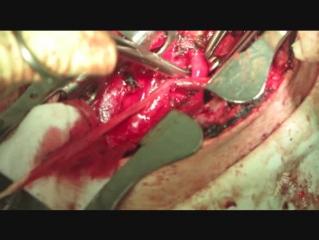 Déconnexion chirurgicale de la fistule trachéo-oesophagienne