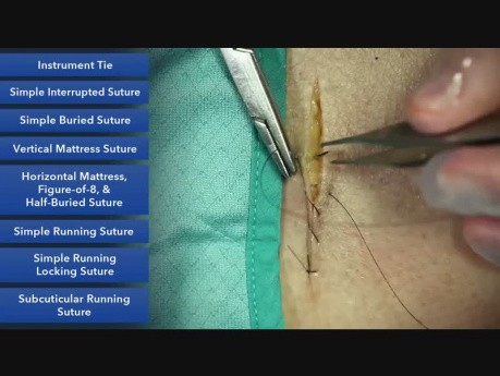 Surjet simple - les techniques de la suture